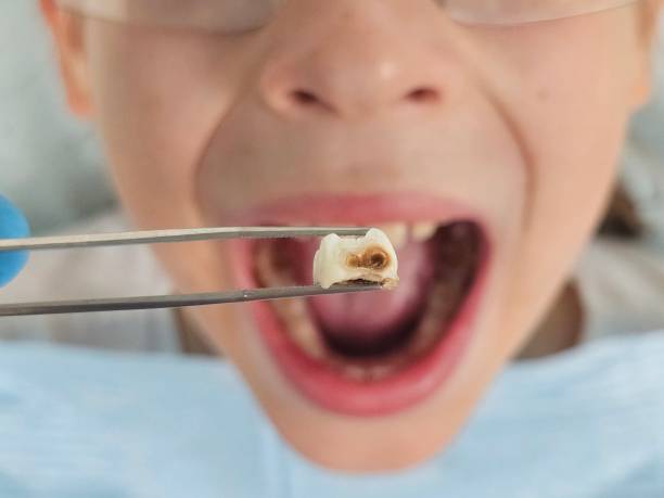Best Emergency Tooth Extraction in Whidbey Island Station, WA