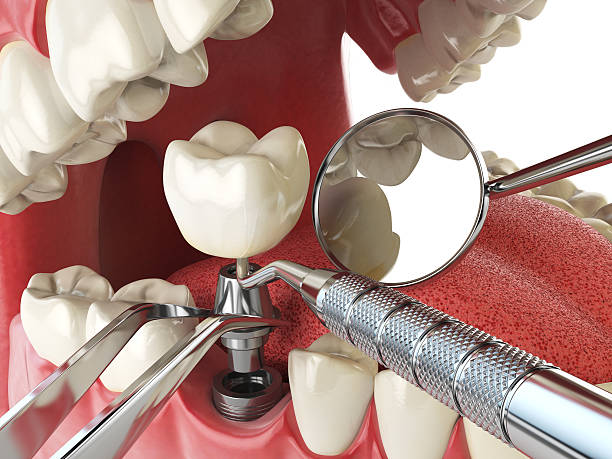 Best Emergency Treatment for Dental Infections or Abscesses in Whidbey Island Station, WA